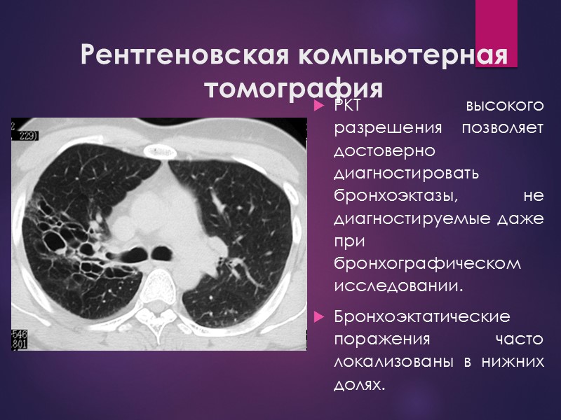 Рентгеновская компьютерная томография РКТ высокого разрешения позволяет достоверно диагностировать бронхоэктазы, не диагностируемые даже при